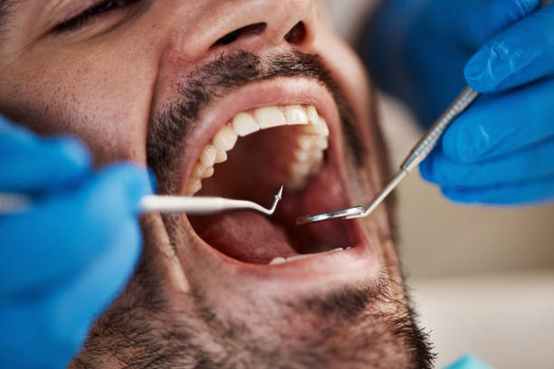 Best Urgent Care for Lost Fillings or Crowns in Eslon, CA